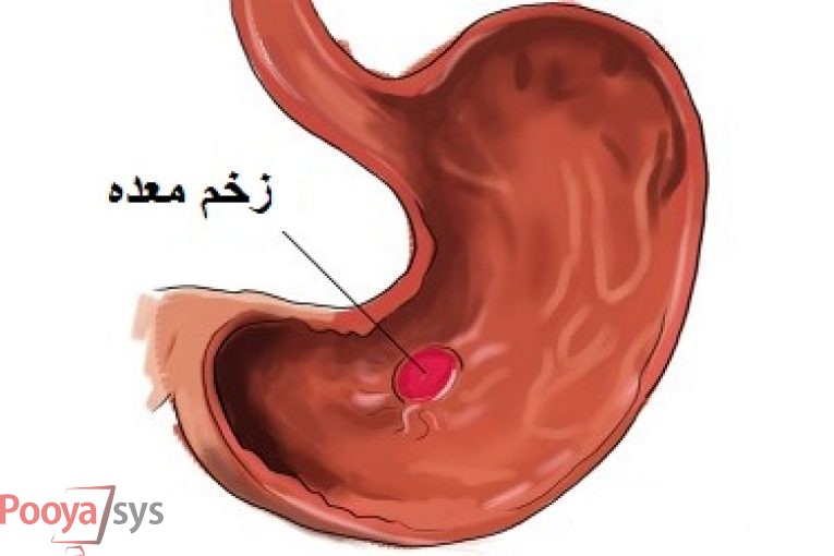 علائم زخم معده