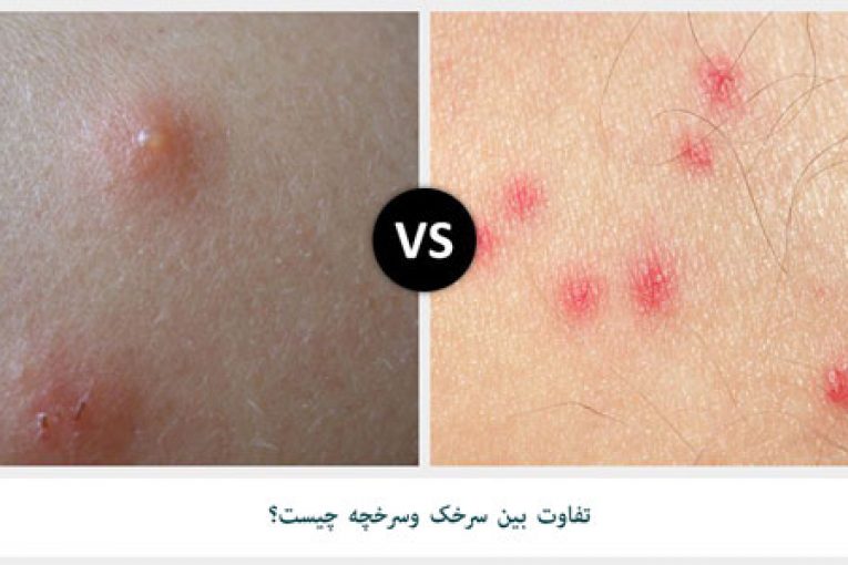 تفاوت بین سرخک و سرخچه چیست؟