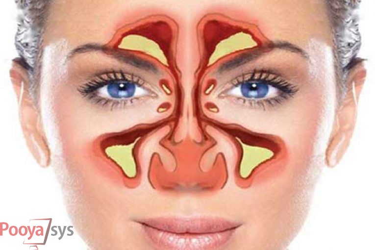 عوارض جراحی بینی