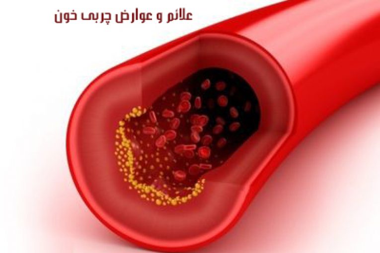 علائم و عوارض چربی خون