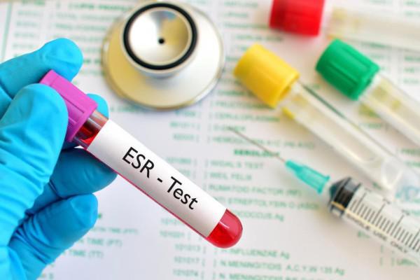 آزمایش خون ESR