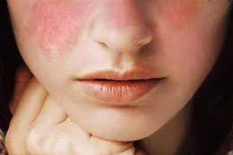 بیماری لوپوس و علائم آن