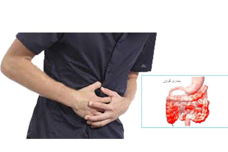 آیا بیماری کرون درمان دارد