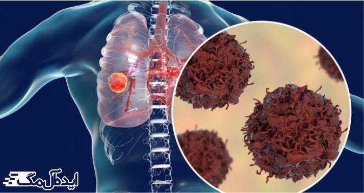 سرطان ریه علائم، انواع، مراحل، درمان دارویی و گیاهی ایده آل مگ