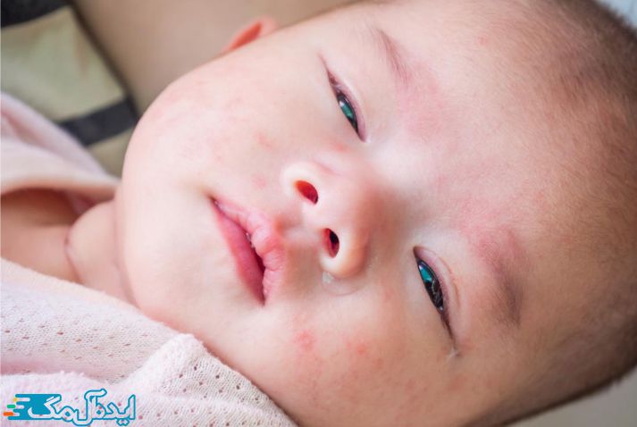 آلرژی در نوزادان