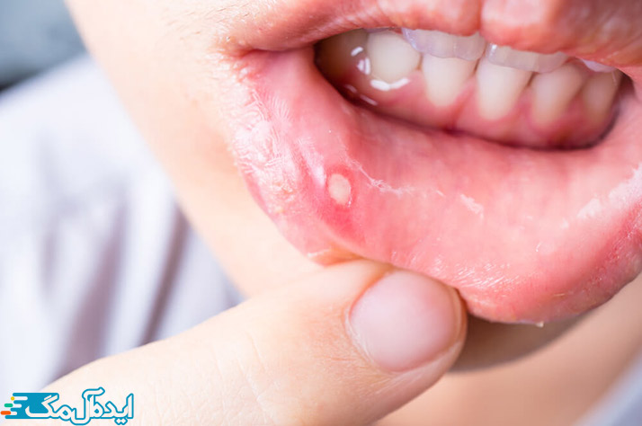 علت بروز زخم در دهان