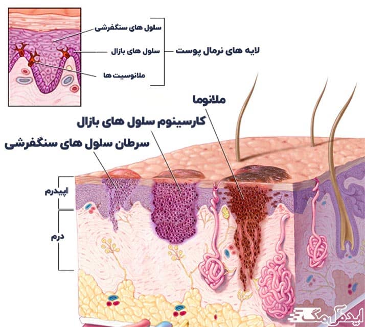 نمای شماتیک پوست و سلول های سرطانی
