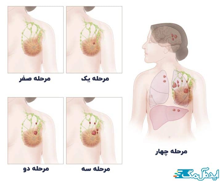مراحل سرطان سینه