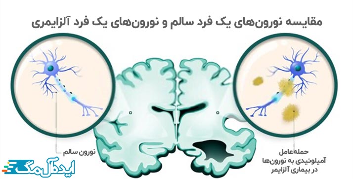عوامل آمیلوئیدی و تخریب نورون ها