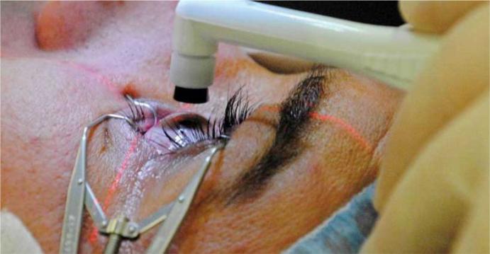 درمان ضعیفی چشم بدون جراحی 
