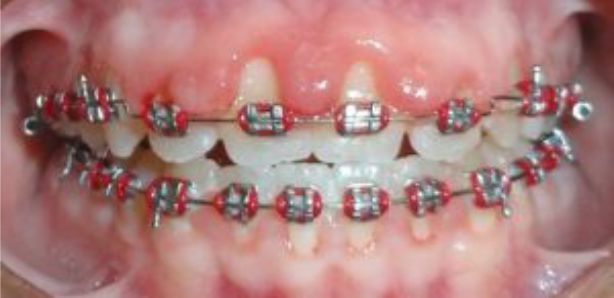 آیا میتوان در طول درمان ارتودنسی دندان ها راسفید کرد؟