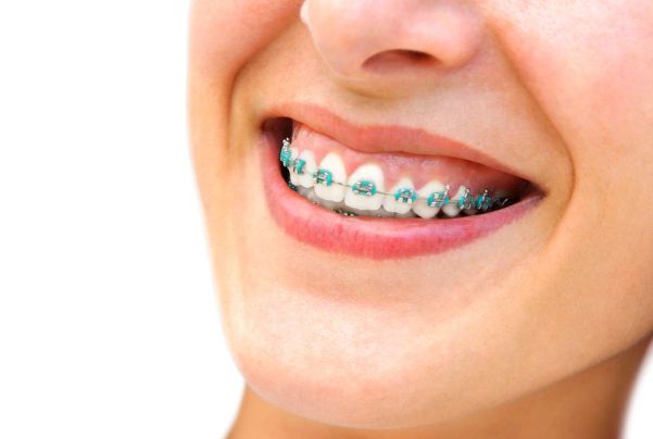 سفید کردن دندان ها بعد از ارتودنسی