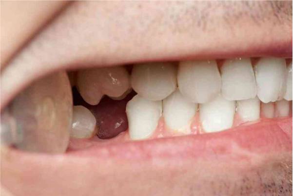 چه کسانی مناسب ایمپلنت دندان هستند ؟