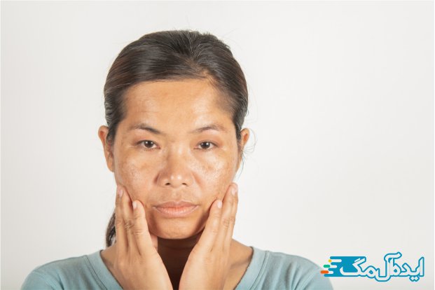 کاهش لکه های پوست از مزایای کرم مرطوب کننده 