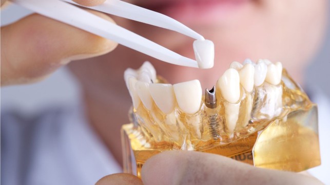 بهترین روش کاشت دندان کدام است ؟ 