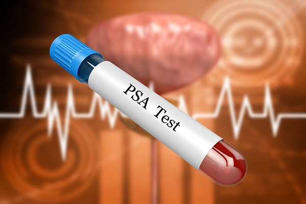 آزمایش خون PSA