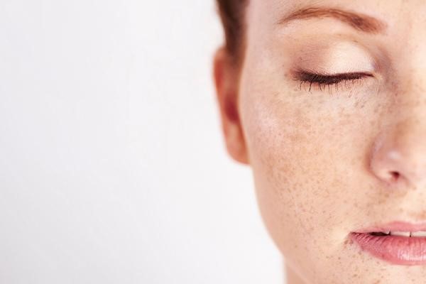 درمان لک صورت با مزوتراپی