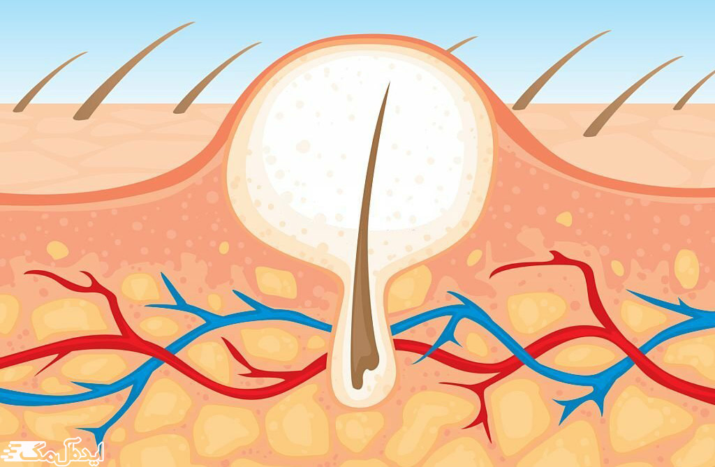 یک تار مو داخل پست به دام افتاده و باعث تشکیل کیست شده است