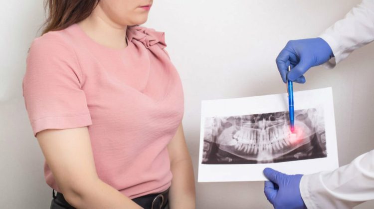 دندانپزشک عکس رادیوگرافی دندان عقل را به بیمار نشان می‌دهد