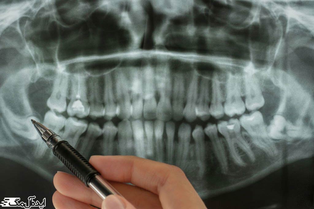 دندان عقل در عکس رادیوگرافی دندان‌ها