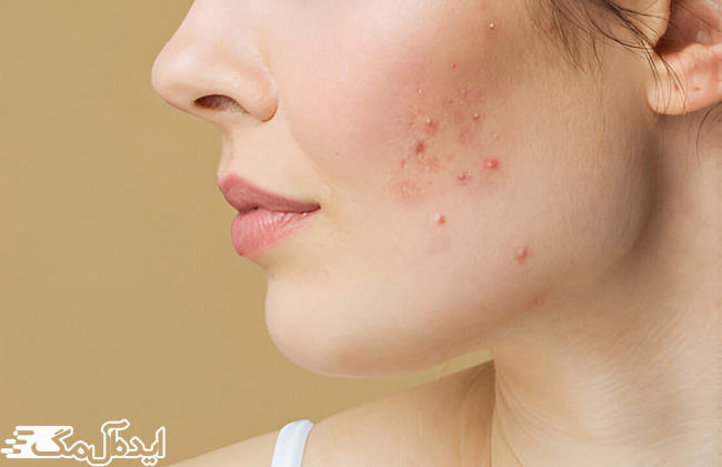 یک زن مبتلا به آکنه
