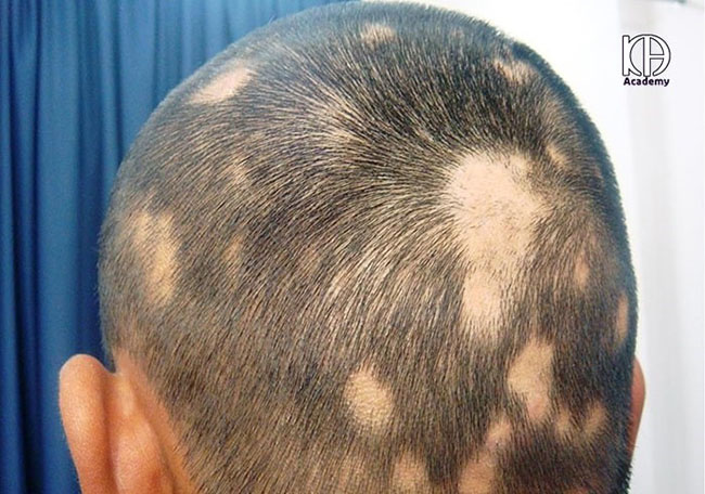 ریزش موی سکهای چند نوع است