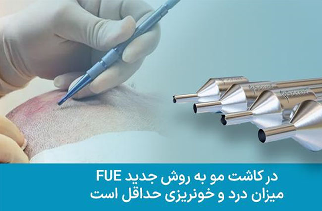 کاشت مو به روش جدید FUE