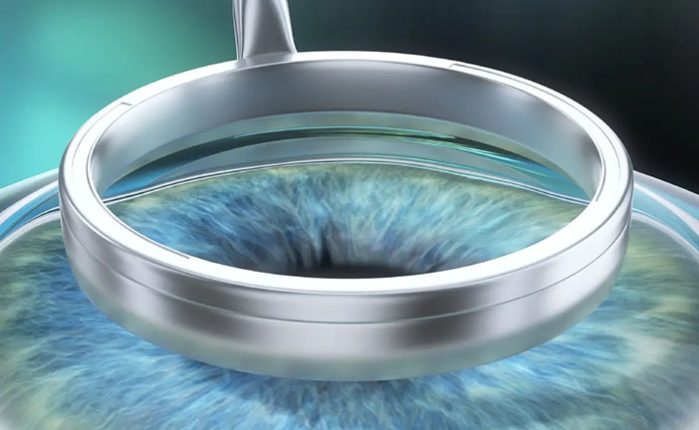 هزینه لازک چشم در سال 1404: راهنمای جامع قیمت، بیمه و عوامل تاثیرگذار