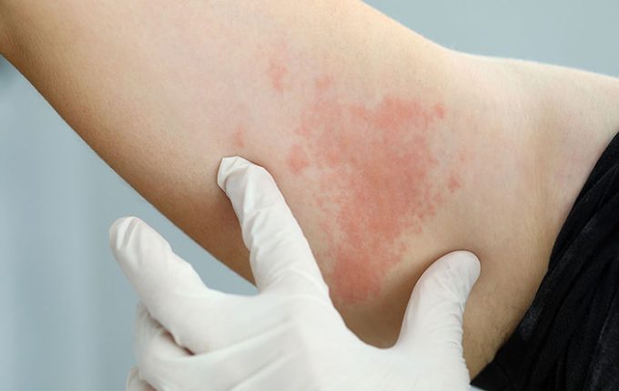 لکه های قرمز روی پوست بدون خارش