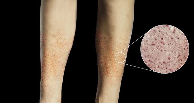 لکه های قرمز ناشی از بیماری پتشی روی پوست پا